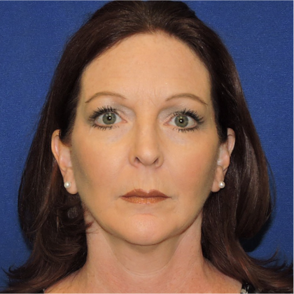Patient 02, view 1 view after facial fat grafting