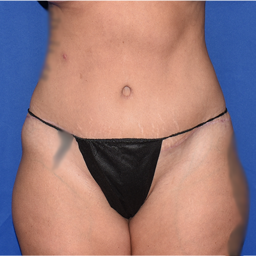 Patient 39, view 1 view after tummy tuck