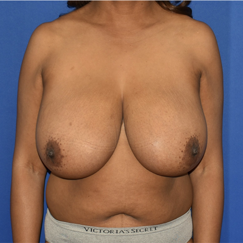 Patient 06, view 1 view before breast reduction