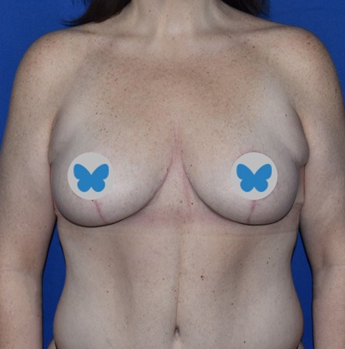 Patient 17, view 1 view after breast lift