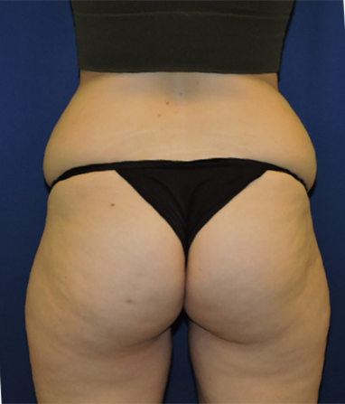 Patient 20, view 1 view before liposuction