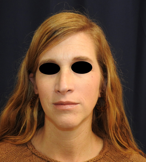 Patient 03, view 1 view before revision rhinoplasty