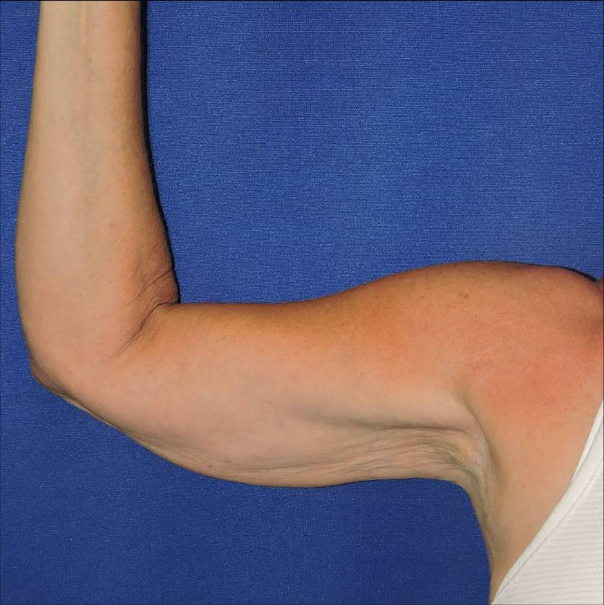 Patient 05, view 1 view before arm lift