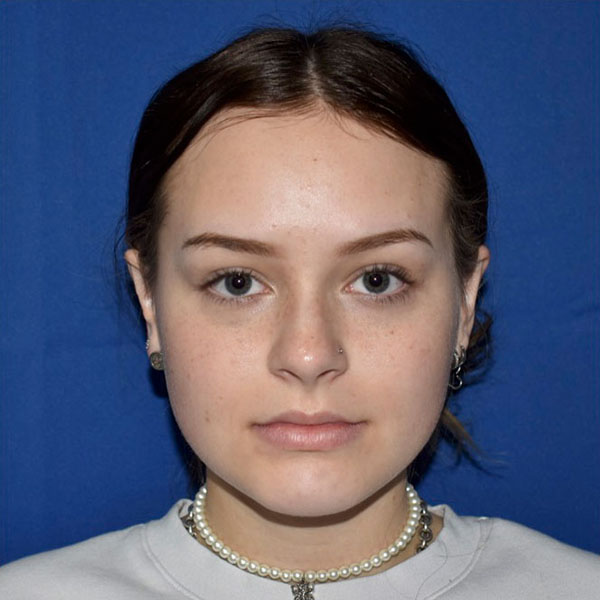 Front view after ear surgery