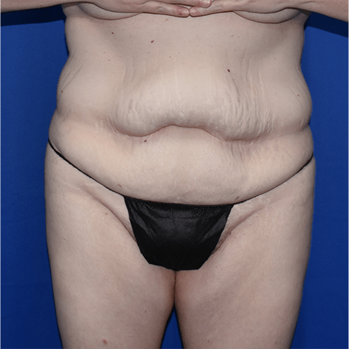 Patient 36, view 1 view before tummy tuck