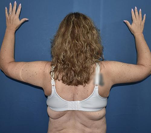 Patient 11, view 1 view after arm lift