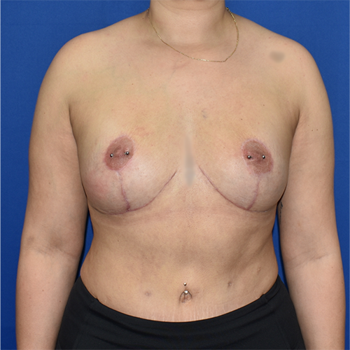 Patient 18, view 1 view after implant removal