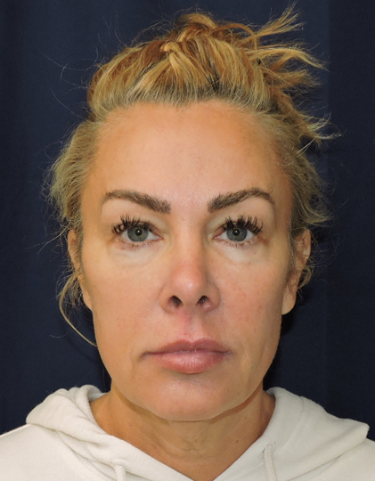 Patient 32, view 1 view before facelift