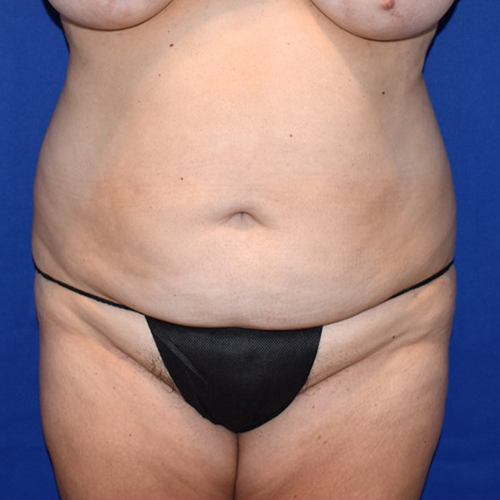 Patient 14, view 1 view before brazilian butt lift