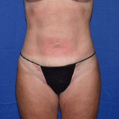 Patient 15, view 1 view after liposuction