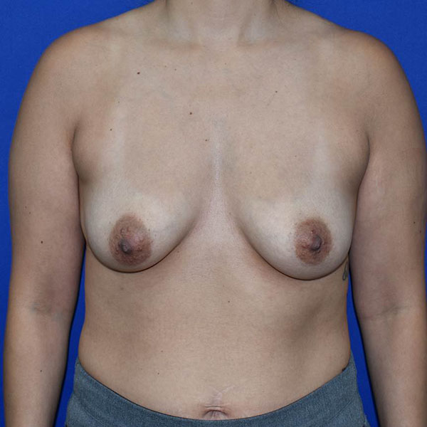 Patient 122, view 1 view before breast augmentation