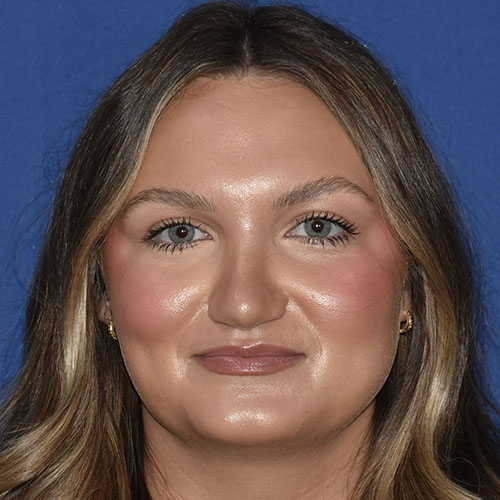 Patient 38, front view after rhinoplasty