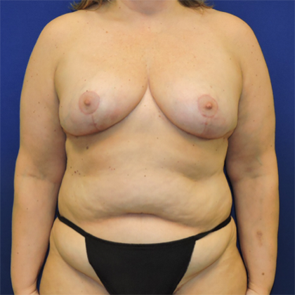 Patient 08, view 1 view after breast reduction