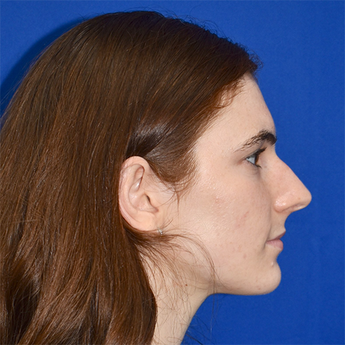 View 3 before rhinoplasty