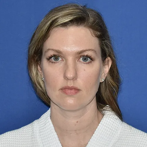 Patient 11, front view before rhinoplasty