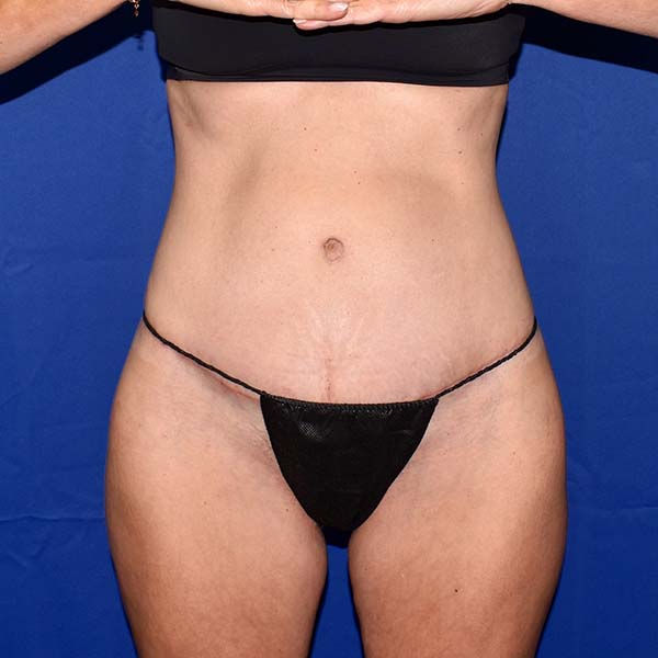 Patient 21, view 1 view after tummy tuck