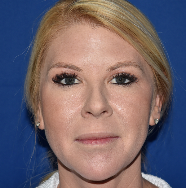 Patient 11, view 1 view after blepharoplasty