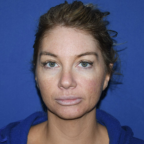 Patient 05, front view after ear surgery