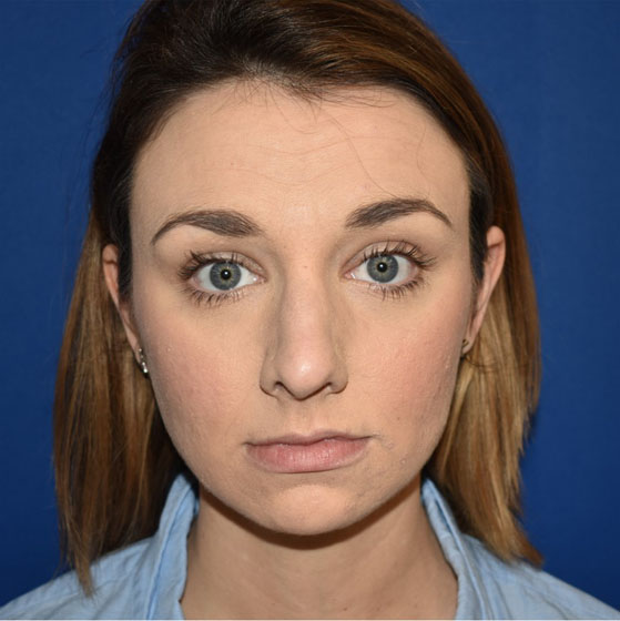 Patient 34, view 1 view before rhinoplasty