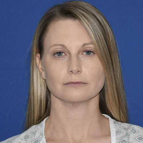 Patient 08, front view after chin liposuction