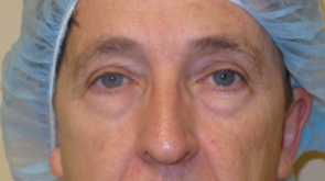 Patient 14, view 1 view before blepharoplasty