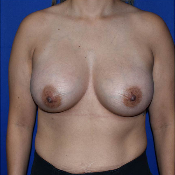 Patient 122, view 1 view after breast augmentation