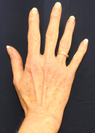 Patient 01, view 1 view before hand rejuvenation