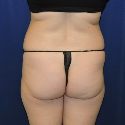 Patient 08, view 1 view before brazilian butt lift