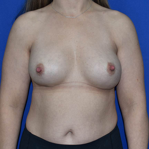 Patient 120, view 1 view before breast augmentation