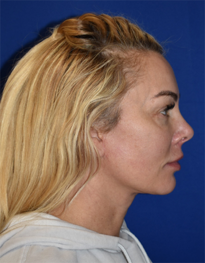 View 3 after neck lift