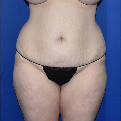 Patient 17, view 1 view before tummy tuck
