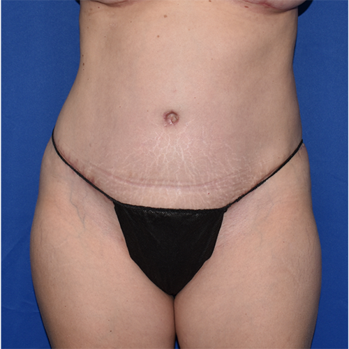 Patient 18, view 1 view after tummy tuck