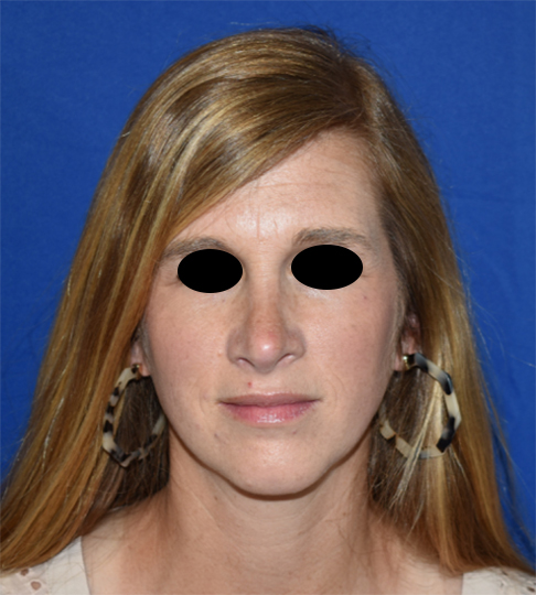 Patient 03, view 1 view after revision rhinoplasty