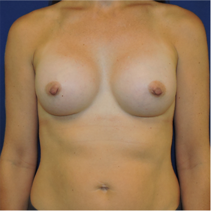 Patient 10, view 1 view after mini breast augmentation