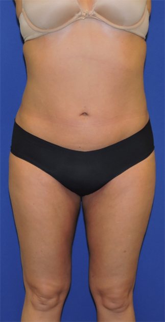 Patient 21, view 1 view after liposuction