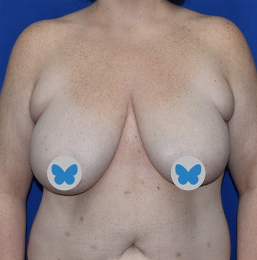 Patient 17, view 1 view before breast lift