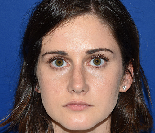 Front view after revision rhinoplasty