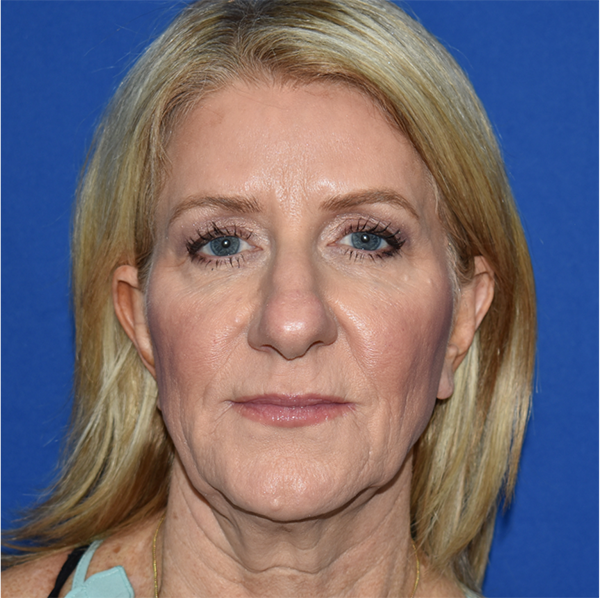 Patient 17, view 1 view before rhinoplasty