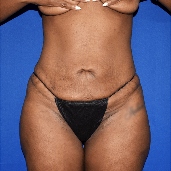 Patient 19, view 1 view before tummy tuck