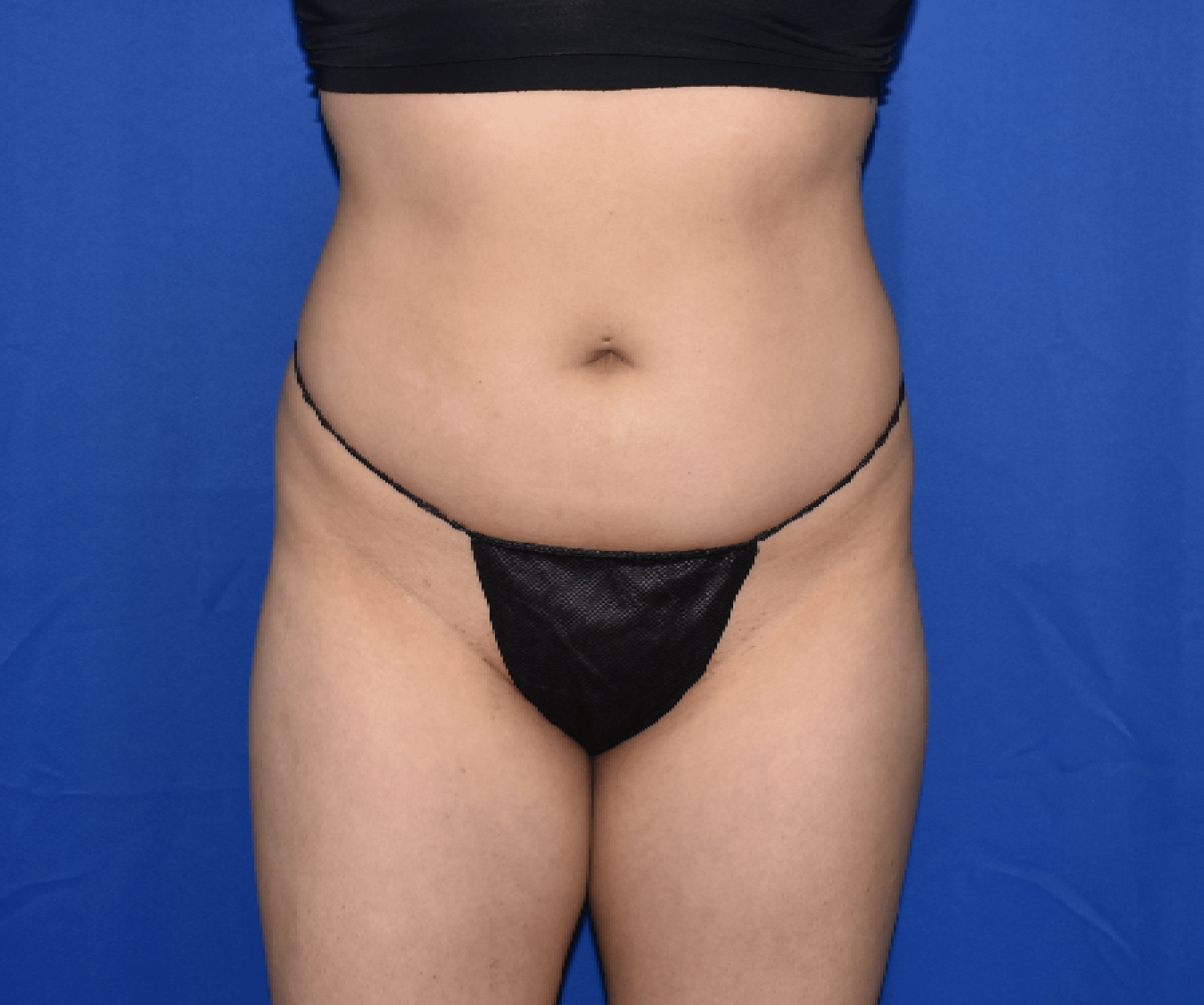 Patient 07, view 1 view before liposuction