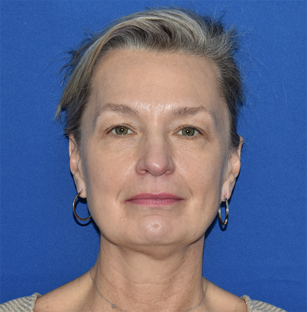 Patient 35, view 1 view before facelift