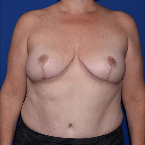 Patient 19, view 1 view after breast reduction