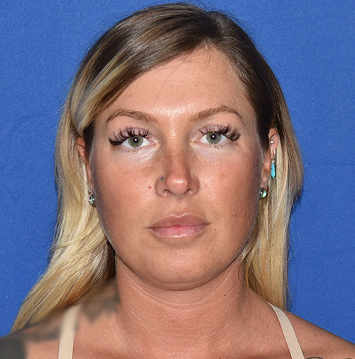 Patient 20, view 1 view before chin liposuction
