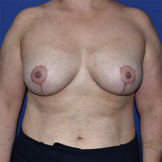 Patient 14, view 1 view after breast lift