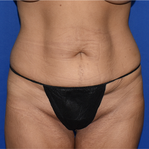 Patient 43, view 1 view before tummy tuck