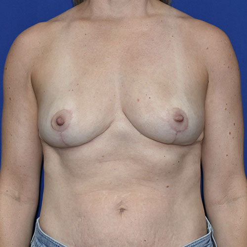 Patient 05, front view after implant removal