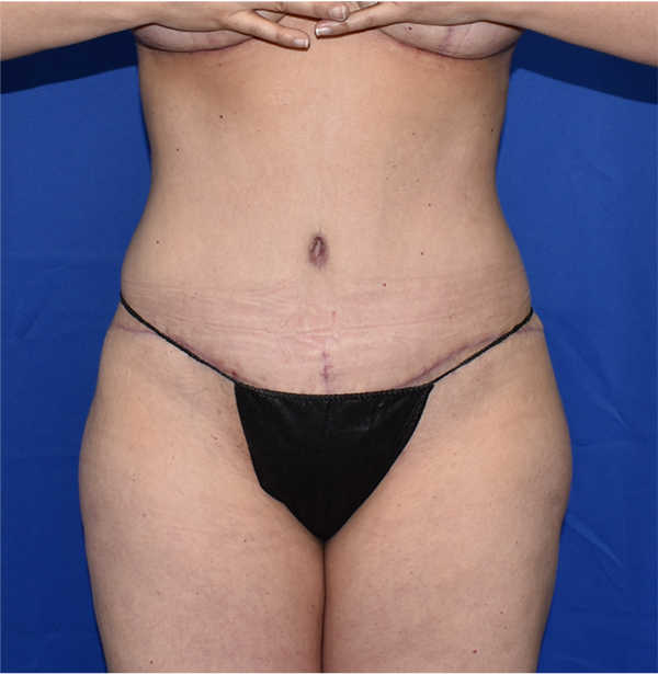 Patient 45, view 1 view after tummy tuck