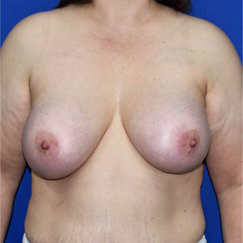 Patient 123, view 1 view after breast augmentation