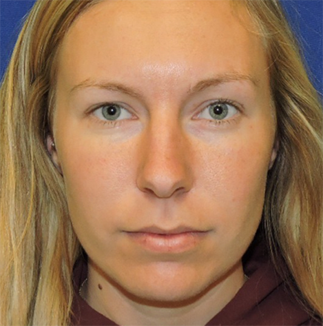 Patient 29, view 1 view before rhinoplasty
