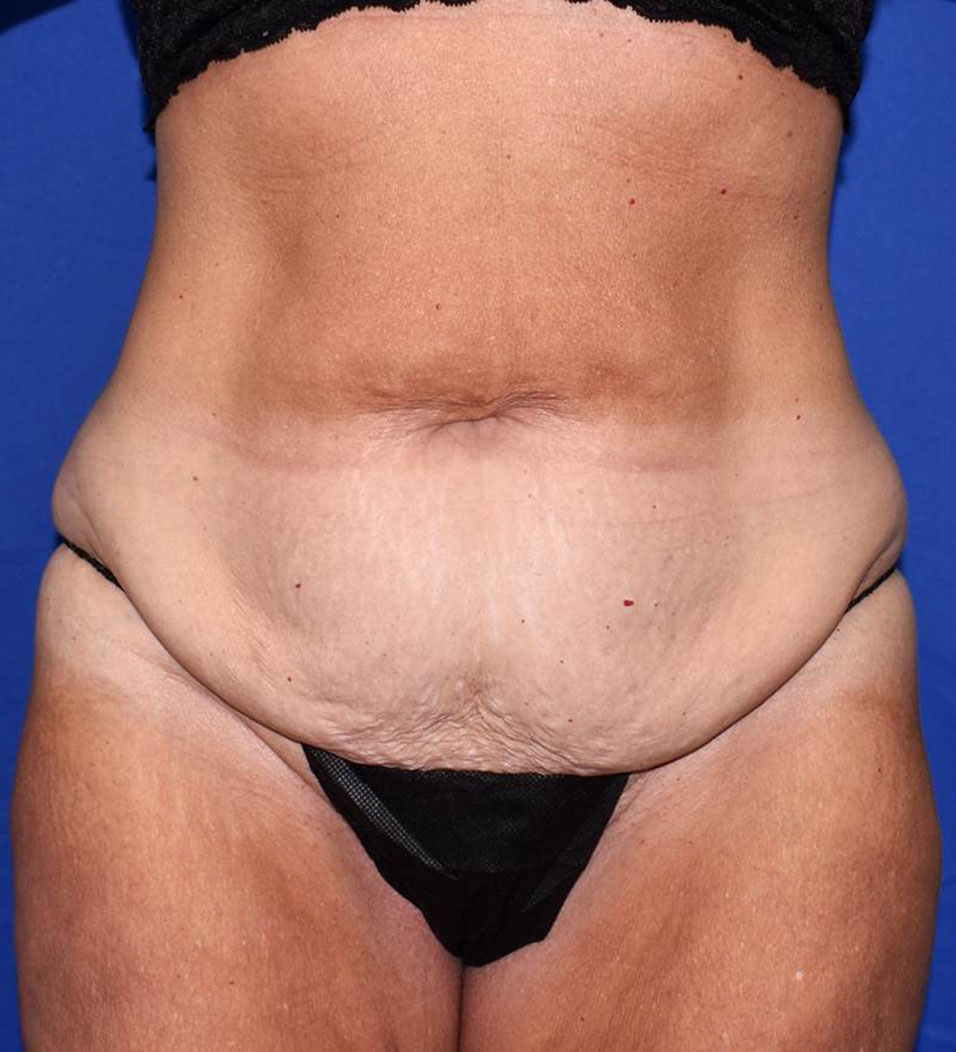 Patient 14, view 1 view before tummy tuck